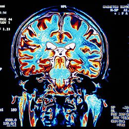 MRI-Scan eines gesunden Gehirns